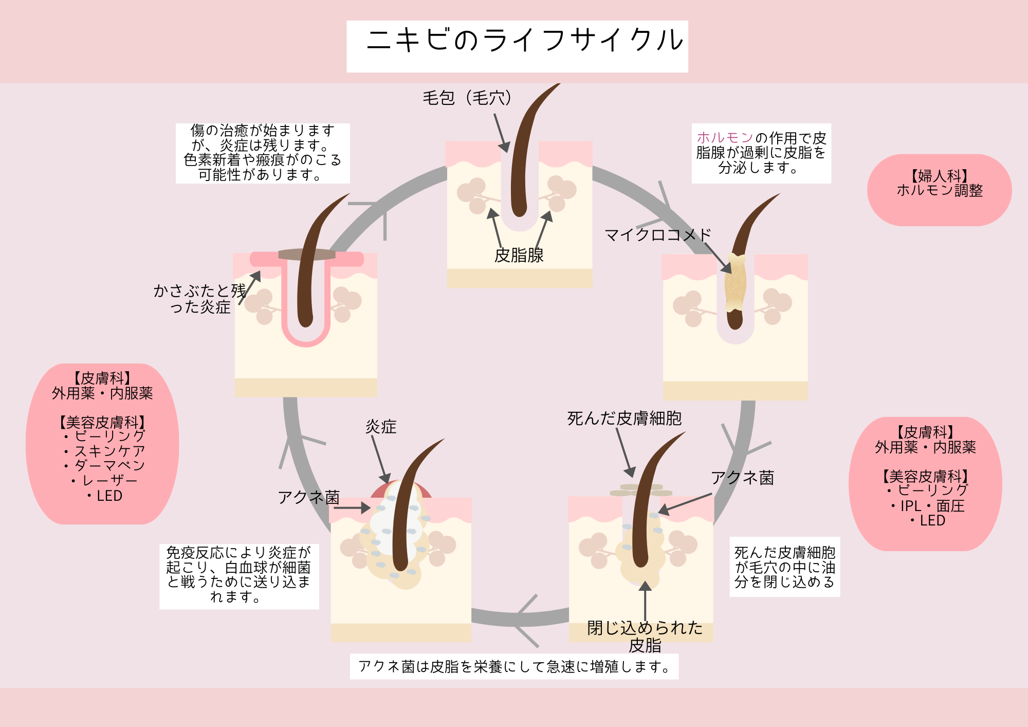 ニキビのライフサイクル