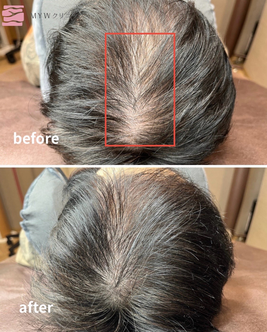 頭皮アートメイク（FIXER）