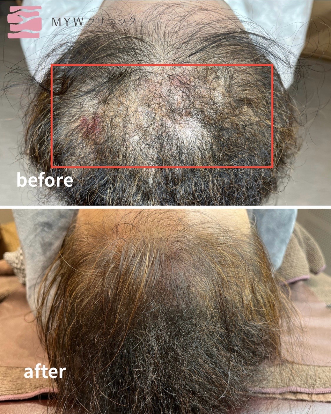 頭皮アートメイク（FIXER）