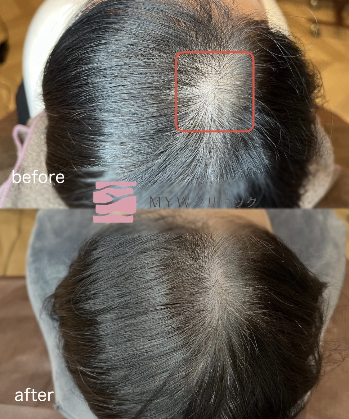 頭皮アートメイク（FIXER）