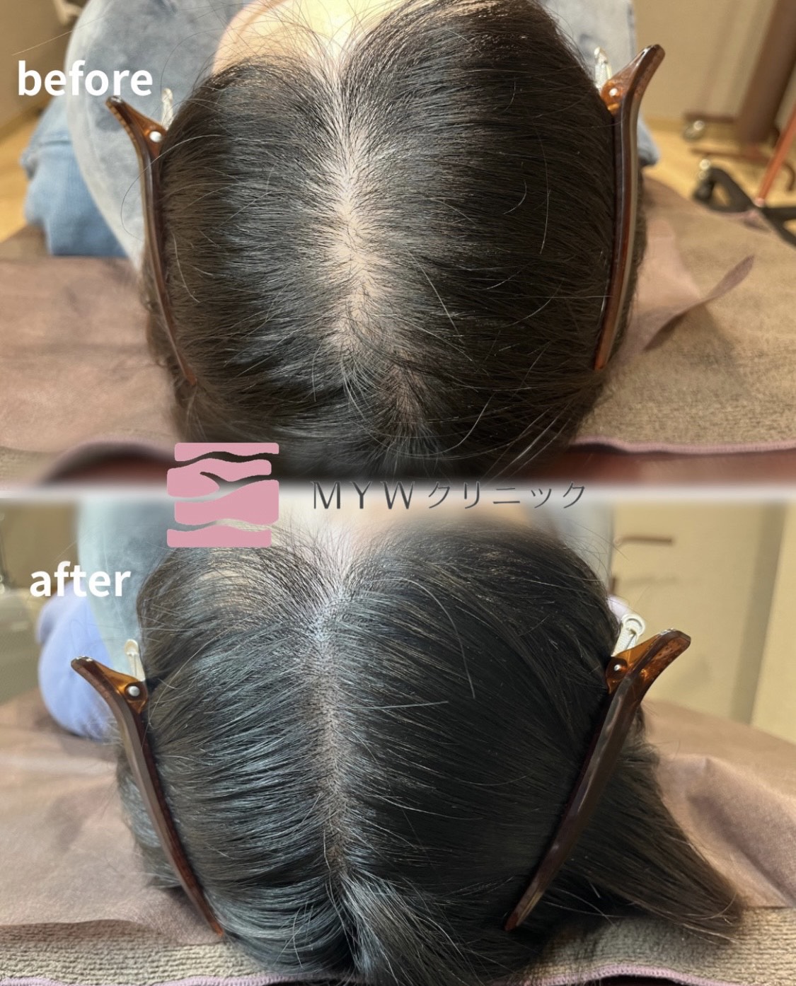 頭皮アートメイク（FIXER）