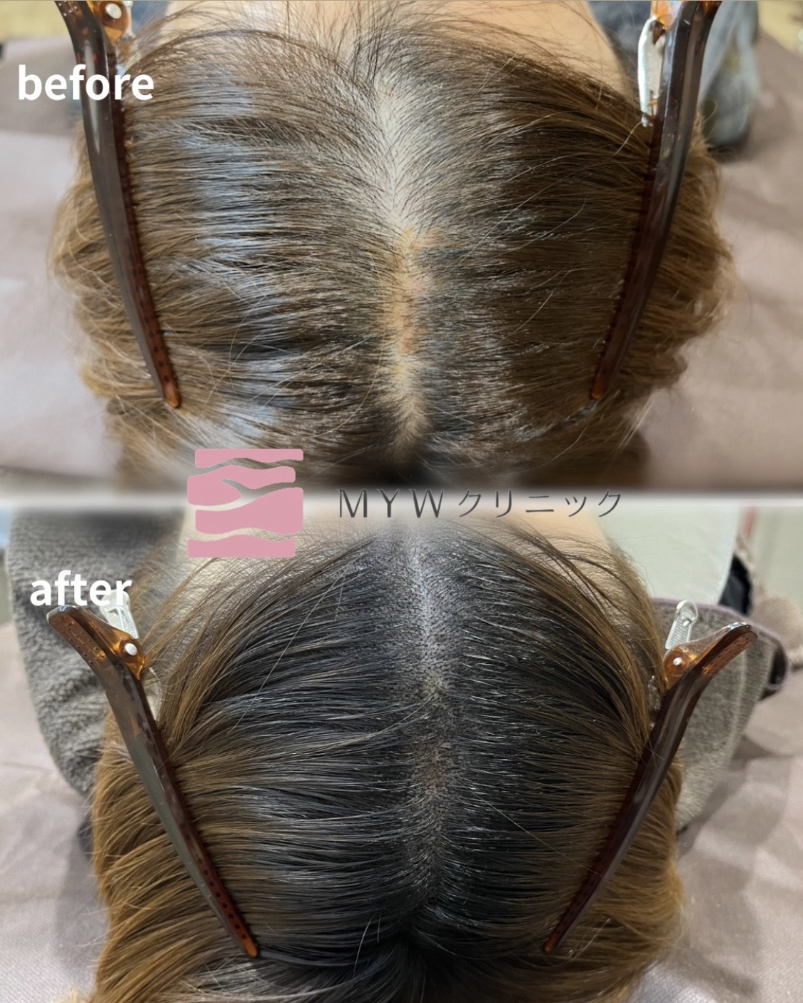 頭皮アートメイク（FIXER）