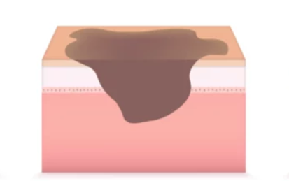 肝斑の肌内部：境界が曖昧で深部まで広がるもやっとした黒ずみ